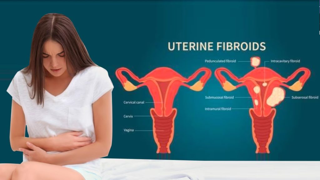 uterine fibroid embolization in lahore