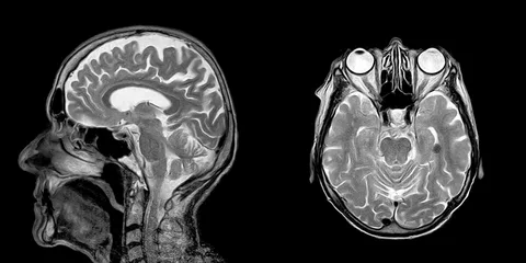 mri brain scan in lahore