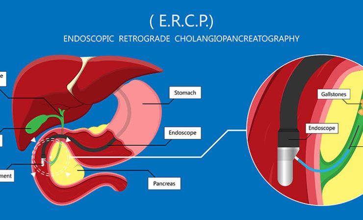 ercp in lahore .low cost