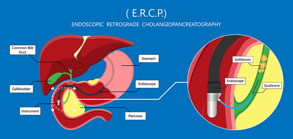 ercp in lahore .low cost