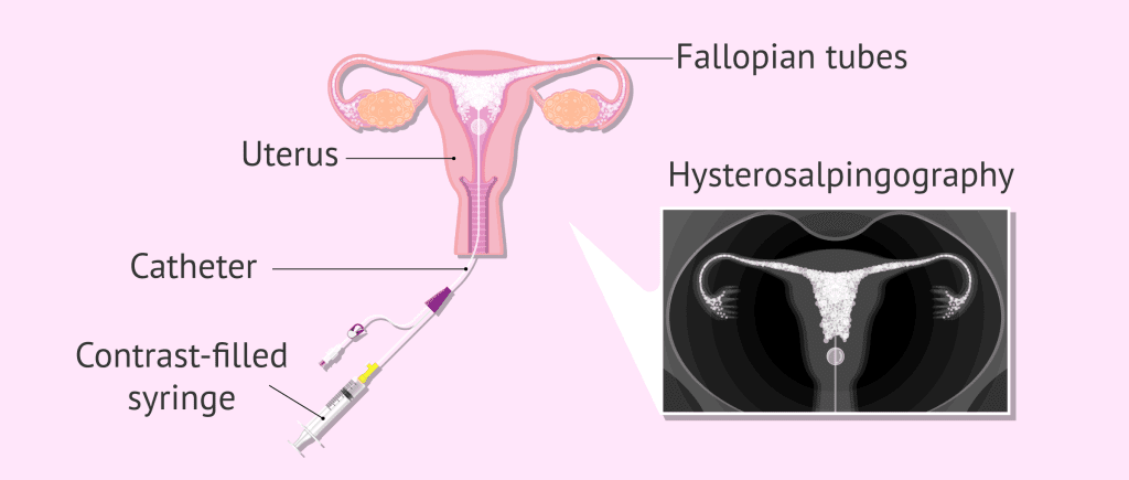 hsg test in lahore