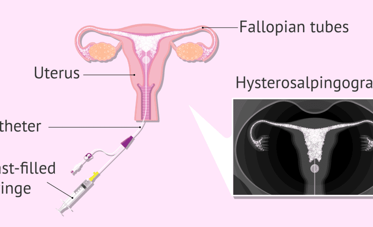 hsg test in lahore